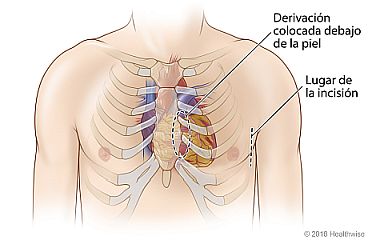 Lugar en el pecho donde se coloca un ICD subcutáneo bajo la piel