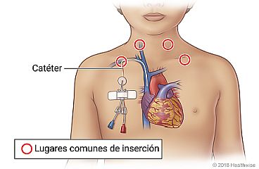Lugares comunes de inserción para un catéter tunelizado