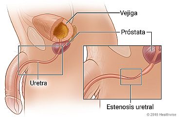 Ubicación de la vejiga, la próstata y la uretra, con detalle de una estenosis uretral