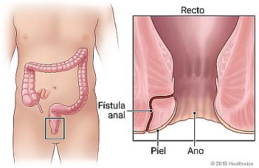 Ubicación del intestino grueso, con detalle del recto y el ano donde se muestra una fístula anal