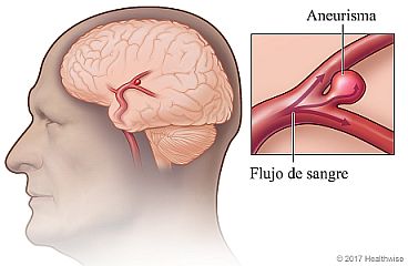Aneurisma en el cerebro, con detalle de la zona abultada en la arteria
