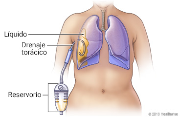 Pulmones en el tórax, mostrando drenaje torácico introducido en el espacio alrededor del pulmón para drenar el líquido hacia un reservorio.