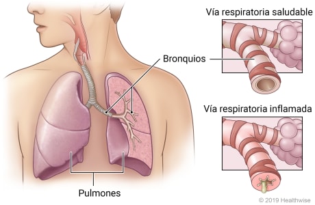 Pulmones en el tórax que muestran los bronquios en el pulmón izquierdo, con detalle de una vía respiratoria saludable y una vía respiratoria inflamada.