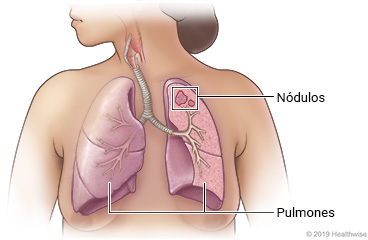 Pulmones en el pecho, con dos nódulos en la parte superior del pulmón izquierdo.