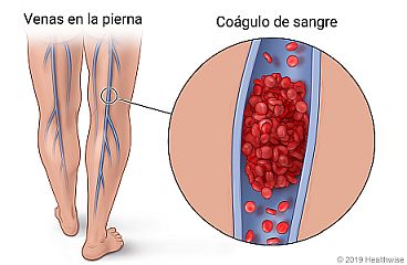 Ubicación de las venas profundas en las piernas, con detalle de un coágulo de sangre en la vena
