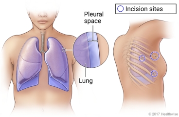 El tórax y el costado, que muestran los pulmones, la cavidad pleural y las zonas de incisión para la toracoscopia