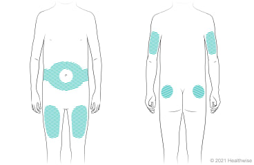 Lugares del cuerpo para aplicar inyecciones de insulina, incluidos alrededor del ombligo en el abdomen, los muslos, zona posterior de la parte de arriba de los brazos y la parte superior de las nalgas.