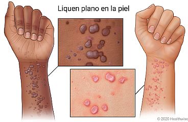 Liquen plano en la piel del lado interno de la muñeca, con primer plano de sarpullido.