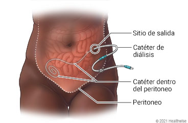 Ubicación del catéter de diálisis fuera del cuerpo y dentro del peritoneo.