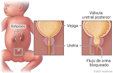 Uretra y vejiga sanas en comparación con uretra con flujo de orina bloqueado a la vejiga (válvula uretral posterior)