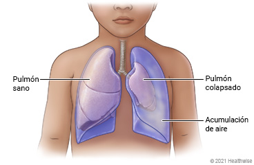 Pulmones en el pecho de un niño, donde se muestra un pulmón sano y un pulmón colapsado.