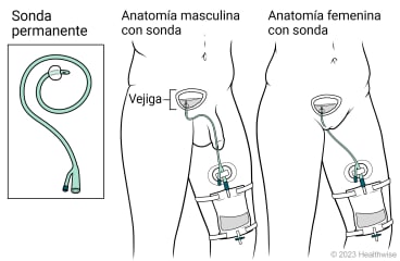 Sonda urinaria permanente