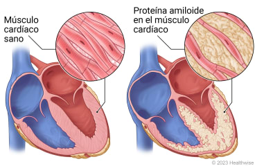 Corazón que muestra músculo cardíaco saludable y corazón que muestra acumulación de proteína amiloide en el músculo cardíaco.