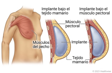 Músculo pectoral en la parte superior del cuerpo, con detalle que muestra un implante colocado entre el músculo pectoral y el tejido mamario y detalle que muestra un implante colocado debajo del músculo pectoral.
