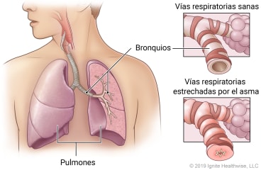 Pulmones en el tórax que muestran los bronquios, con detalles de las vías respiratorias sanas y las vías respiratorias estrechadas por el asma.