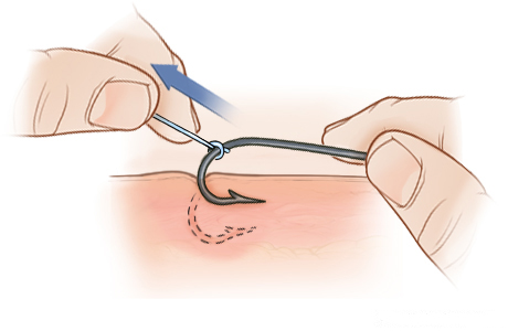 Paso C: Tire del hilo para sacar la púa