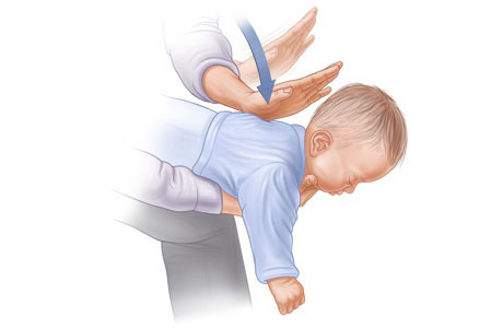 Imagen C: Posición del bebé sobre el brazo para la maniobra de Heimlich; se muestran la posición y la dirección de las palmadas en la espalda