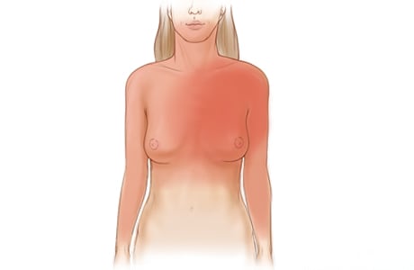 Imagen de las zonas más comunes en las que se sienten los síntomas de angina