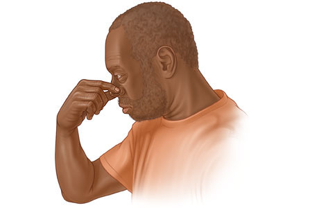 Hombre apretándose la nariz para detener una hemorragia nasal.