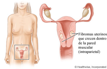 Fibromas uterinos