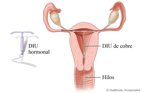 Imagen de un dispositivo intrauterino (DIU)