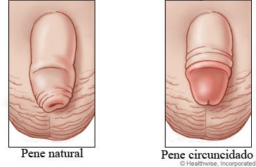 Penes natural y circuncidado