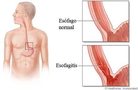 Esófago normal comparado con uno con esofagitis