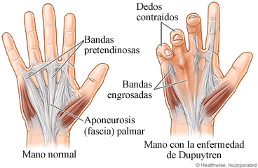 Mano normal y mano con la enfermedad de Dupuytren