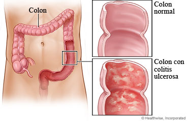 Un colon normal y uno con colitis ulcerosa