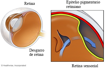 Retina desprendida