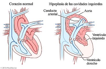 Corazón normal y corazón que muestra una aorta y un ventrículo izquierdo más pequeños (hipoplasia de las cavidades izquierdas) junto con el conducto arterial