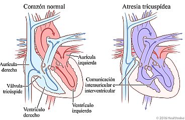 Corazón normal y corazón sin una válvula tricúspide, que muestra un ventrículo derecho más pequeño y cambio en la circulación de la sangre