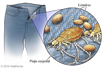 Piojos del cuerpo en las costuras de un pantalón, con primer plano de piojo y liendres