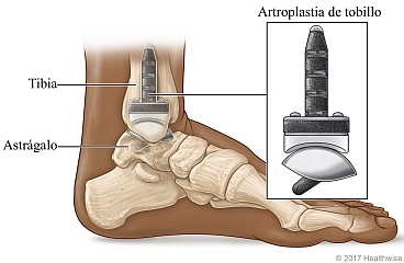 Parte inferior de la pierna y pie, donde se muestra la tibia, el astrágalo y una prótesis de tobillo.