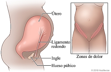 Ubicación del ligamento redondo y las zonas de dolor asociadas con él