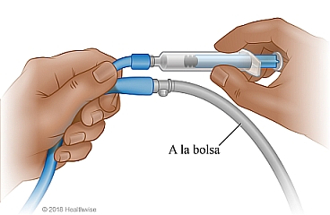 Una sonda de Foley tiene dos vías de acceso: una para la bolsa de orina y otra para conectarla a la jeringa para drenar el globo.