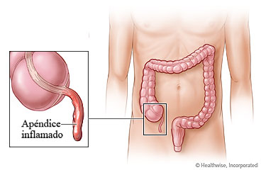 Apendicitis y ubicación del apéndice