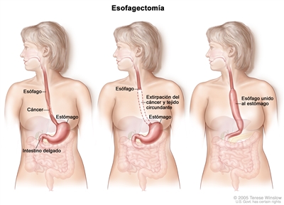 El dibujo a tres paneles muestra una cirugía del cáncer de esófago; el primer panel muestra el área del esófago con cáncer, el panel del medio muestra la extirpación del cáncer y el tejido circundante, y el último panel muestra como se estira el estómago y se une al resto del esófago.