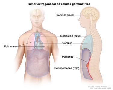 Tumor extragonadal de células germinativas. En el dibujo se muestran las partes del cuerpo donde los tumores extragonadales de células germinativas se pueden formar, incluso la glándula pineal en el encéfalo, el mediastino (área entre los pulmones) y el retroperitoneo (área detrás de los órganos abdominales). También se señalan el corazón y el peritoneo.