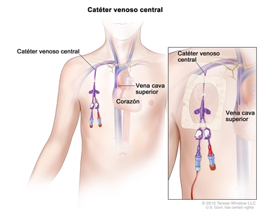 Catéter venoso central. En el dibujo del tronco de un joven, se señala el corazón y la vena cava superior. Al lado derecho del corazón, se observa un catéter venoso central que va desde una vena debajo de la clavícula hasta la vena cava superior, que es una vena grande que se conecta con el corazón. En una ampliación, se muestra el catéter venoso central en el lado derecho del tórax cubierto por un apósito plástico transparente.