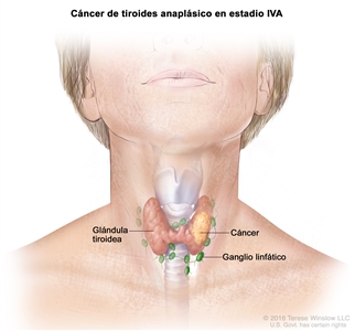 Cáncer de tiroides anaplásico en estadio IVA. En la imagen se muestra el cáncer en la glándula tiroidea. También se muestran los ganglios linfáticos.