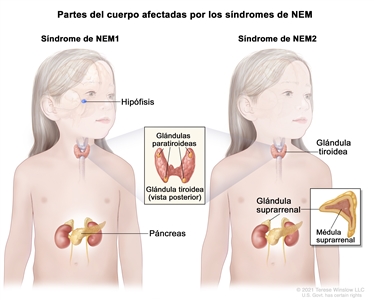 Partes del cuerpo afectadas por los síndromes de neoplasia endocrina múltiple (NEM). Se observan dos dibujos del cuerpo de una niña. En el dibujo de la izquierda, se señalan la hipófisis, y el páncreas, que son partes del cuerpo que afecta el síndrome de NEM1. En el dibujo de la derecha, se señalan la glándula tiroidea y una glándula suprarrenal, de donde sale una ampliación que muestra la médula suprarrenal, que son partes del cuerpo que afecta el síndrome de NEM2. En la mitad de los dos dibujos, se encuentra un recuadro donde se observa la vista posterior de la glándula tiroidea y se señalan las cuatro glándulas paratiroideas, cuyo tamaño es similar al de una arveja, tanto NEM1 como NEM2 afectan las glándulas paratiroideas.