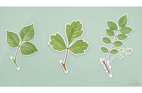 Hiedra, roble o zumaque venenosos: Qué hacer primero (subtitulado)