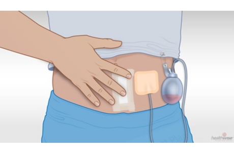 Cómo cuidar un drenaje quirúrgico (subtitulado)