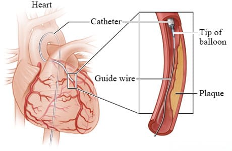 Guide wire and tip of balloon in narrowed artery.