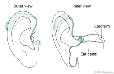 Outer and inner view of a mini BTE hearing aid placed in ear.