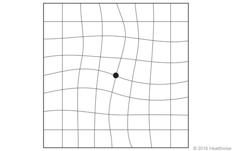 Amsler grid with wavy lines