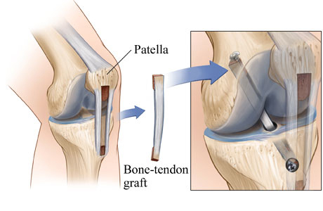 Picture of a bone and knee tissue graft for ACL surgery