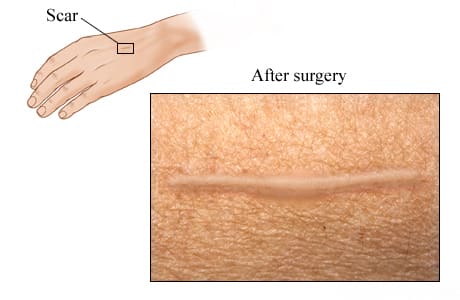 Scar after excision for melanoma