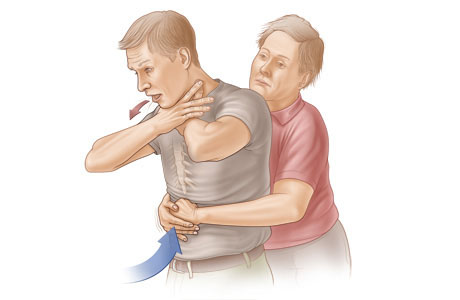 Choking rescue procedure (Heimlich maneuver) with an adult.